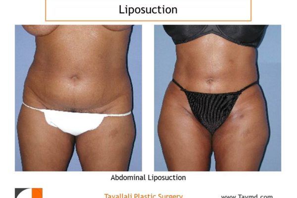 Liposuction, Ashburn, Northern Virginia