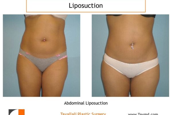 Liposuction of abdomen-360 lipo