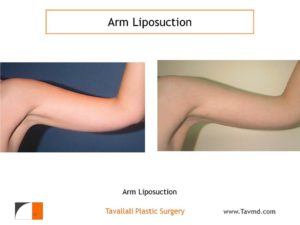 Arm liposuction result in thin woman