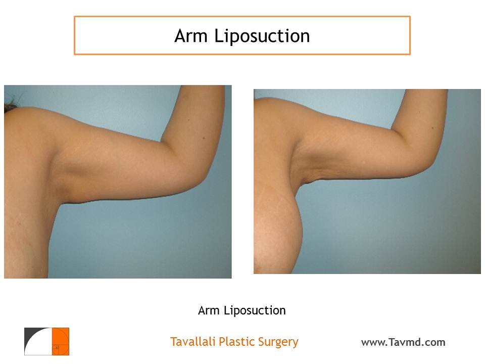 Arm liposuction photos/info