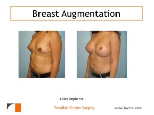 Breast enlargement 425 cc implants