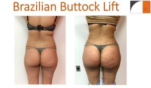 BBL Brazilian buttock lift liposuction hips fat injection