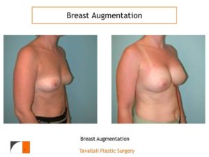 Breast augmentation surgery result Virginia