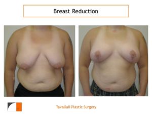 Breast reduction surgery before after