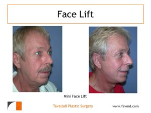 Man after and before mini facelift surgery