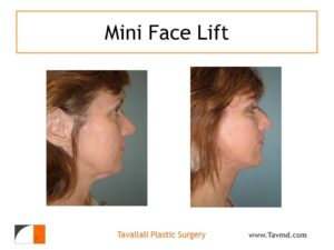 Young woman before after neck lift surgery