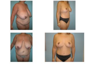 Multiple views Tummy tuck and breast reduction surgery