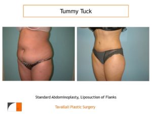 Full Tummy tuck abdominoplasty lipo flanks before after