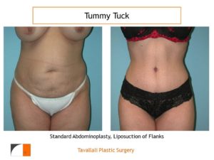 Small woman before after tummy tuck abdominoplasty surgery