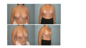 Breast reduction result with vertical mammoplasty before after